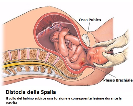 Distocia della Spalla