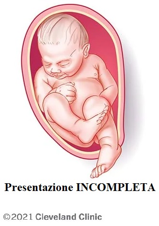 Parto Podalico: Rischi, Complicazioni e Supporto Legale