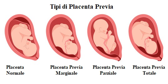 lacenta Previa e Lesioni Neonatali