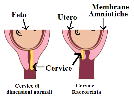 progesterone in gravidanza e responsabilità dei medici
