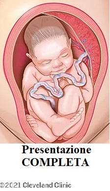 Parto Podalico: Rischi, Complicazioni e Supporto Legale