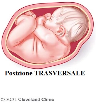 Parto Podalico: Rischi, Complicazioni e Supporto Legale