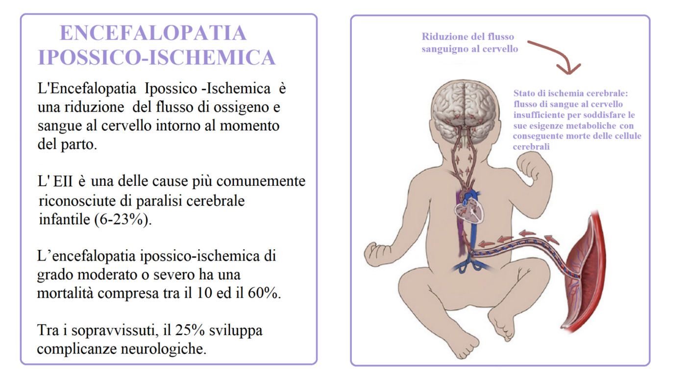 Encefalopatia Ipossico-Ischemica e Risarcimento per Danni