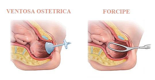 Uso Improprio di Ventosa Ostetrica e Forcipe nel POV
