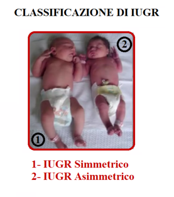 IUGR: Ritardo di Crescita Intrauterino e Conseguenze per il Neonato