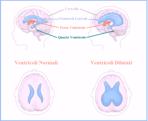 Danni al Neonato e Dilatazione Ex Vacuo dei Ventricoli Cerebrali: Diritto al Risarcimento