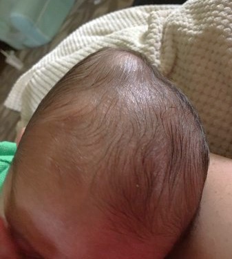 Cefaloematoma Neonatale: Complicazioni e Risarcimento